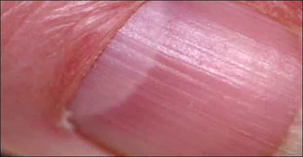 An anaemic nail