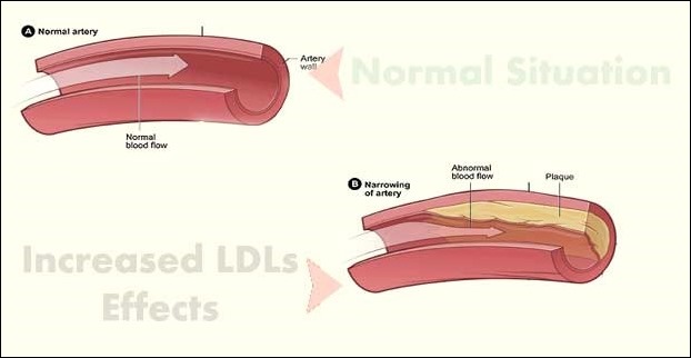 An increased risk of heart disease and atherosclerosis prevails in case of increased LDL