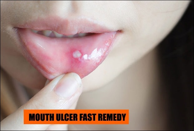 Application of mIlk help in treatment of mouth ulcer due to the presence of calcium in it.