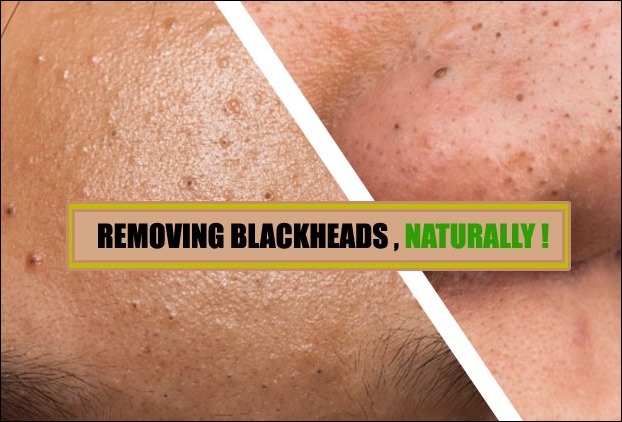 How to remove blackheads from nose naturally - 7 Best Methods