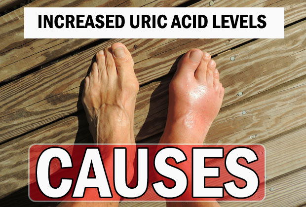 Causes of Increased Uric Acid Levels in Human Body