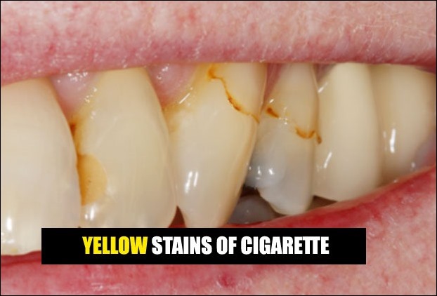 Cigarette Stains on White Teeth