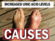 Causes of Increased Uric Acid Levels in Human Body