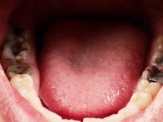 How Does Tooth Decay Affect Your Health?