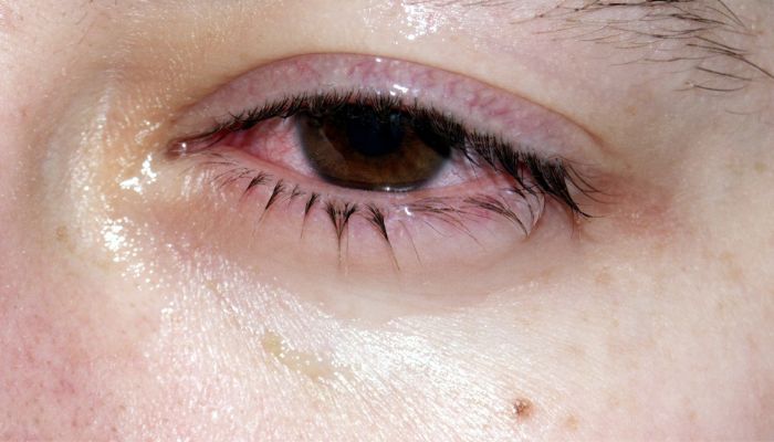 Conjunctivitis, commonly known as pink eye, is a very common eye condition that affects people of all ages. 