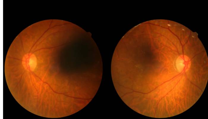 Diabetic retinopathy - a common eye problem, is a complication of diabetes and a leading cause of vision loss.