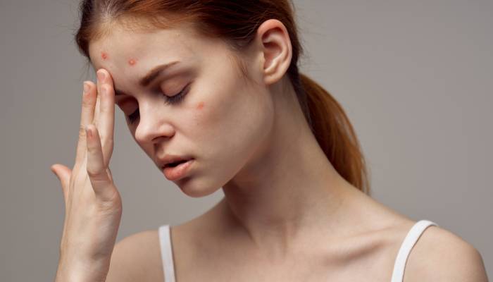 Acne and its Root Causes 