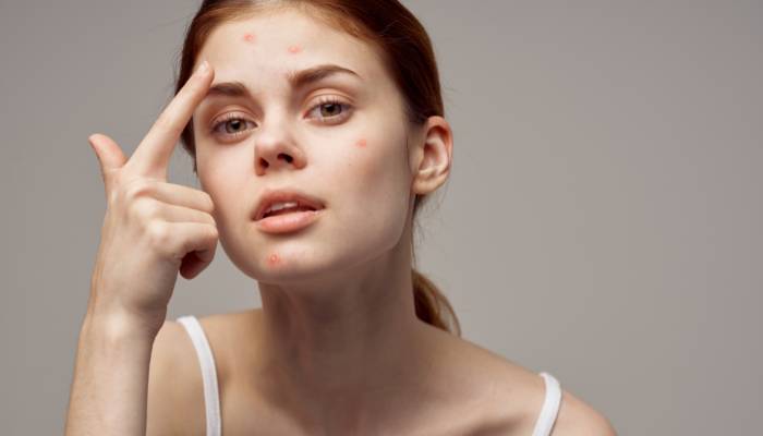 Teenage years – The source for acne breakout