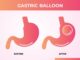 gastric baloon pros and cons discussed