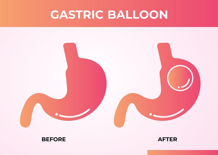 Review : Gastric Balloon pros and cons