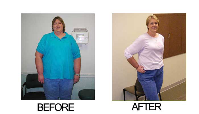 Weightloss surgery benefits : gastric sleeve vs gastric band