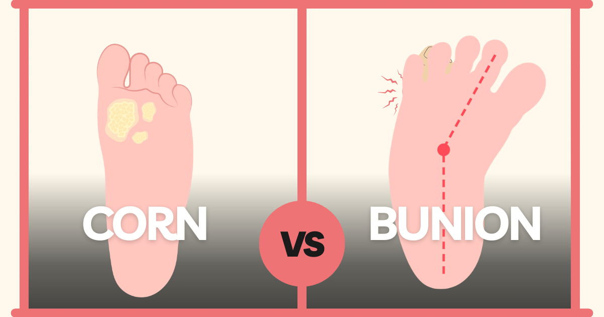 What is the Difference Between a Corn and a Bunion? An Insight Lifebing
